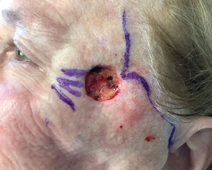 5.-Melanoma-surgical-excision