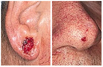 basal cell carcinoma basal cell carcinoma bcc