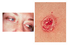 Basal cell carcinoma basal cell carcinoma bcc