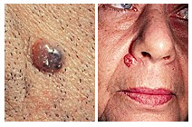 BCC-slider-4 basal cell carcinoma woman's face