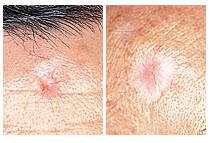 BCC-slider-5 basal cell carcinoma bcc