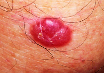 Basal cell carcinoma copy