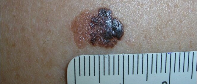 Large melanoma with varied colors