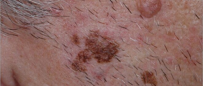 Melanoma with asymmetry and irregular borders