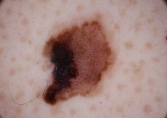 Melanoma1