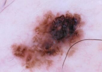 Melanoma4