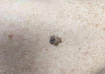 Melanoma Image Melanoma, 1.3mm, right posterior shoulder. Photo: Sarah Gee, MD