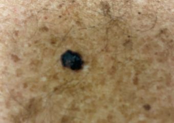Nodular melanoma 1.3mm upper back courtesy EK Hale 1.25.22 Nodular melanoma 1.3mm on upper back