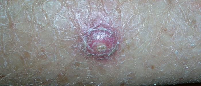 Raised, red, scaly squamous cell carcinoma