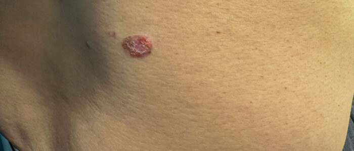 Raised, reddish squamous cell carcinoma Raised, reddish squamous cell carcinoma