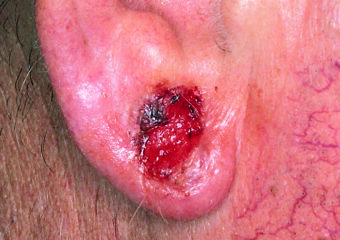 SCF_Basal cell carcinoma presenting as an open sore on the ear 700