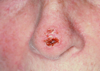 SCF_Squamous cell carcinoma on the nose