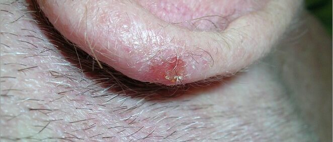 Squamous cell carcinoma on ear