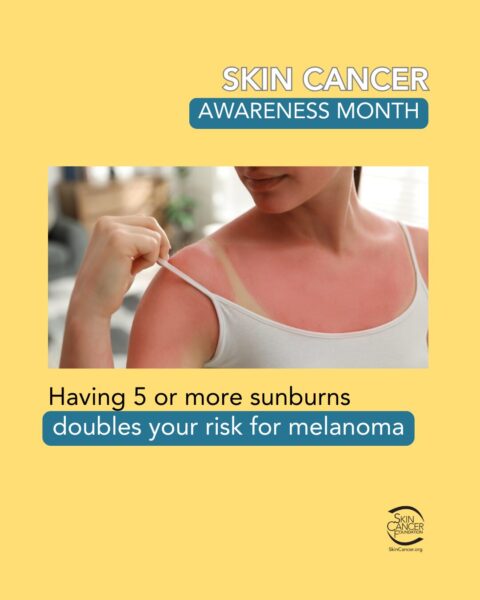 A Skin Cancer Awareness Month poster with a photo of a woman with sunburn and a warning about increased melanoma risk.