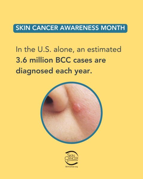 Skin Cancer Awareness Month image with information about BCC diagnosis rates in the U.S. and a photo of a skin lesion.