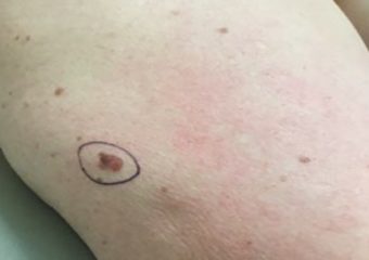 Superficial melanoma 0.55mm Upper Arm Courtesy EK Hale 1.25.22 Superficial melanoma 0.55mm Upper Arm