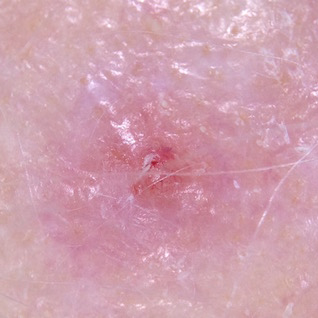 amelanotic-melanoma-scalp-crop A nodular melanoma developing within an amelanotic melanoma in situ on the scalp.