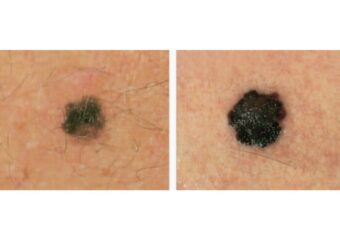 evolving-melanoma-journal evolving melanoma