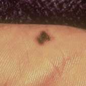 figure4b acral lentiginous melanoma
