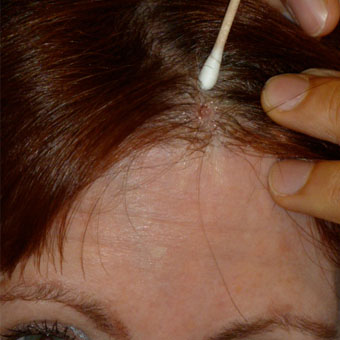 julie-2 skin cancer lesion removed