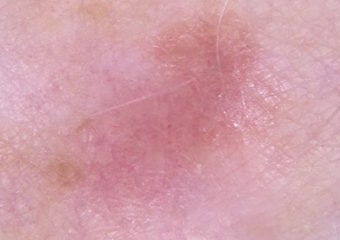 melanoma on leg An example of a flat, amelanotic, superficial spreading melanoma on the leg.