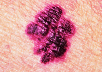melanoma-irregular borders