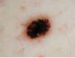 Picture of melanoma Picture of melanoma skin cancer