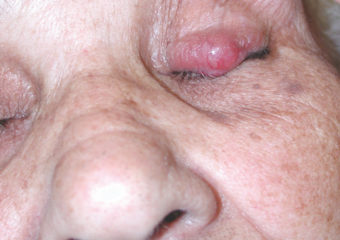 merkel-cell-eyelid Picture merkel cell carcinoma on woman's left eyelid