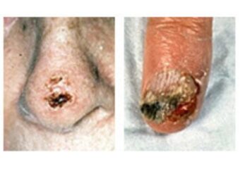 scc 3 Une plaie ouverte qui saigne, forme des croûtes et persiste depuis plusieurs semaines.